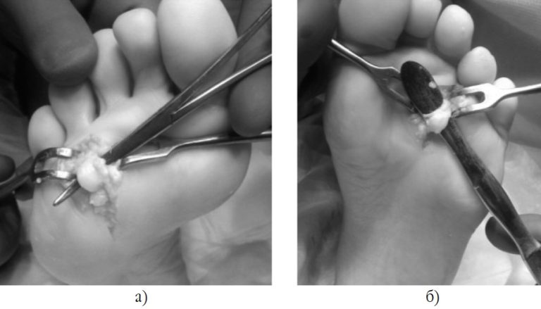 УЗД суглобів і нервів верхніх та нижніх кінцівок з навігаційним блоком