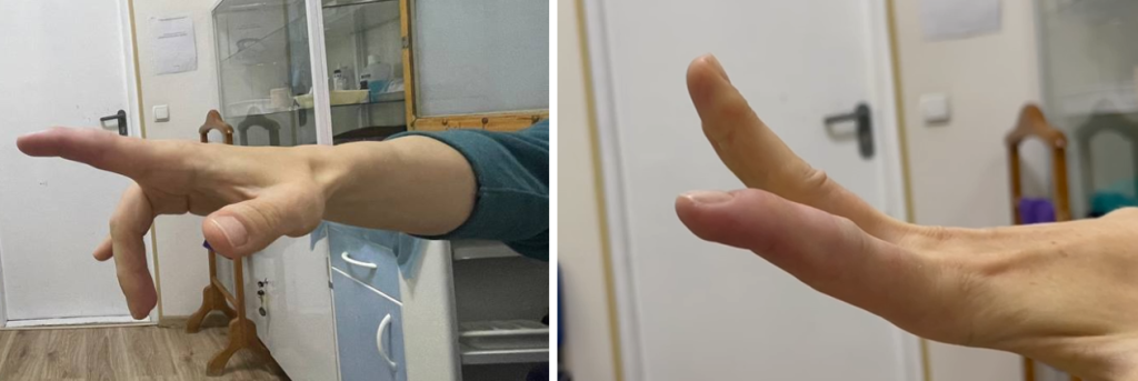 Пошкодження сухожилків розгиначів пальців кисті на рівні дистальної фаланги